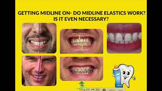 Getting Midlines on- Invisalign/ Braces / Midline Elastics