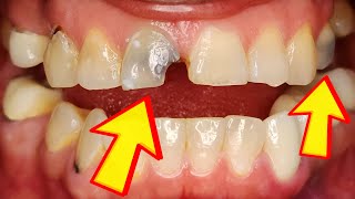 Dentist Explains Every Cause of Gray Teeth & Why Your Tooth is Turning Grey, Dark, & Possibly Dying!
