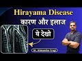 Hirayama Disease कारण और इलाज   Hirayama spine