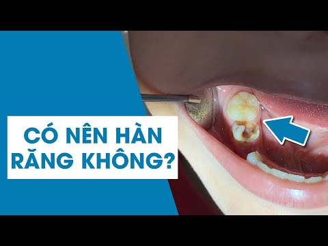Có nên hàn răng sâu cho trẻ không? | Nhakhoaoze.com