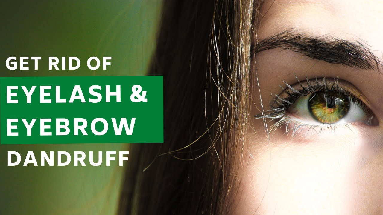 How to Remove Dandruff from Eyelashes & Eyebrows Naturally Just with