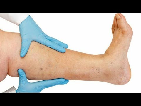 نصائح عند ارتداء جوارب الدوالي