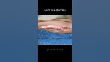"Leg Fasciotomies Unveiled: Essential Knowledge in Shorts" #shorts #shortsvideo
