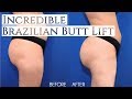 Incredible Brazilian Butt Lift (BBL) Before & After