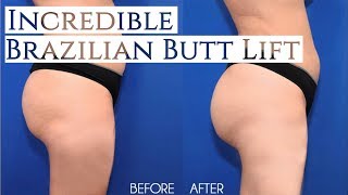 Incredible Brazilian Butt Lift (BBL) Before & After