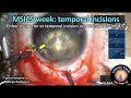 Cataractcoach 1466 msics temporal incisions