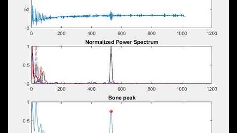 Ultrasound signal processing