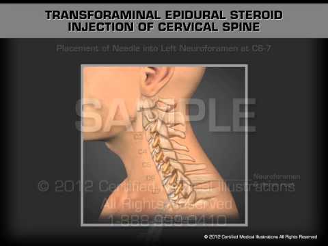 Transforaminal Epidural Steroid Injection CSpine - YouTube