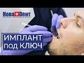 🔑  Что включает в себя имплантация зубов под ключ. Имплантация зубов под ключ. НоваДент. 12+