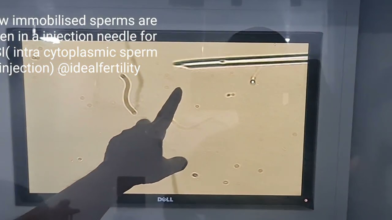 Live demonstration of Ovum pickup and ICSI