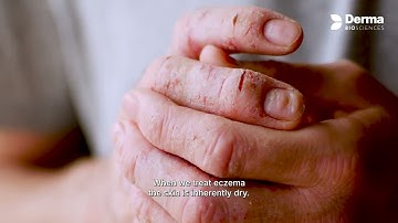 Eczema Treatment - Derma Biosciences