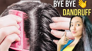 How to Cure Dandruff  Naturally at Home | Remove In Just 1 Wash Permanently 💕