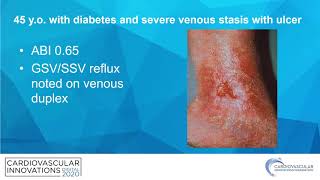 Arterial and Venous Intervention for Limb Salvage - Christopher Huff, MD, FACC