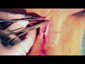 Labiaplasty Surgery Part 2 | Detailed Procedure by Dr. Hanna, Oxnard, Ventura County