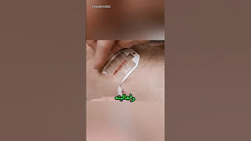 اختراع طبي يغلق الجروح في ثوان أدق من الجراحة بـ8 مرات 