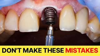 Your Dental Procedure Is Over... But You're Not Done Yet
