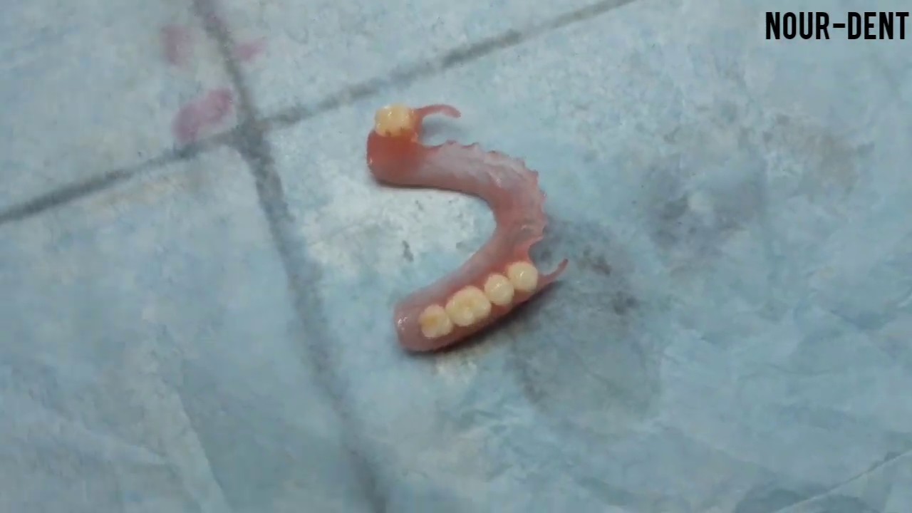 Valplast dentaire du haut.