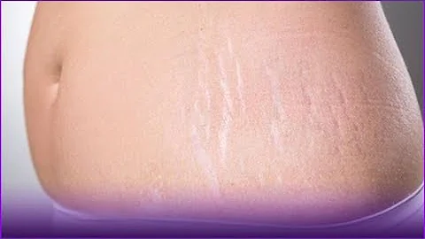 Tem como cobrir estrias com tatuagem?