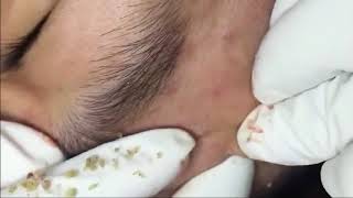 How to remove whiteheads and blackheads (Part 45) - DARINANA Resimi