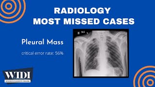 Most Missed Cases: Pleural Mass