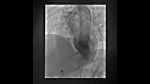 LV angiogram post ADO I device closure of a high muscular VSD
