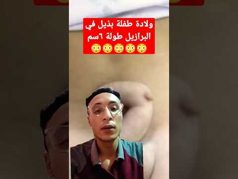 ولادة طفلة بذيل في البرازيل مصر   أخبار الكويت الامارات   