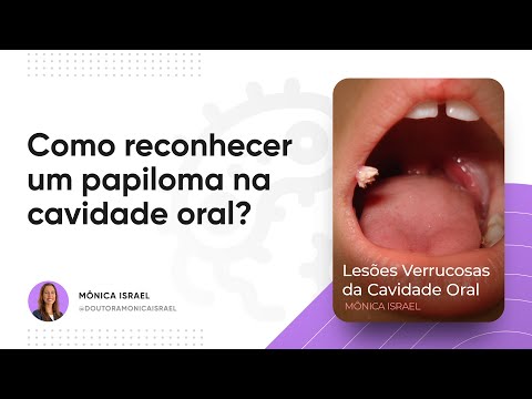 Vídeo: Com que frequência os papilomas são cancerígenos?