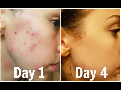 How I Got Rid of My Acne Scars Forever (Guaranteed Clearer Skin in  Days)