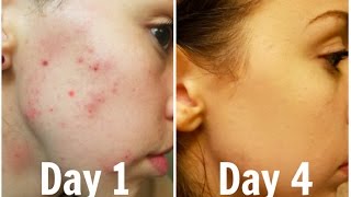 How i permanently got rid of my acne forever! support me & videos by
donating to patreon: https://www.patreon.com/jenniferfix get 10% off
your first de...