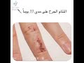مراقبة إلتئام جرح في ٣٣ يوم 