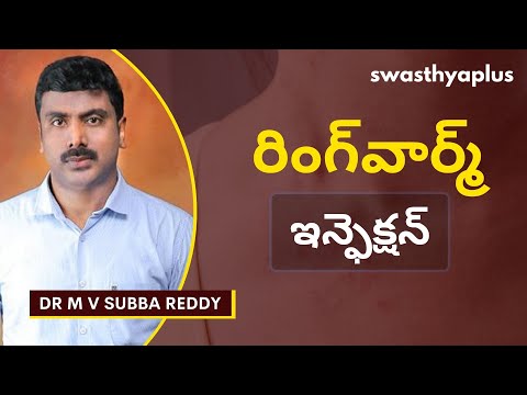 రింగ్‌వార్మ్ ఇన్‌ఫెక్షన్ నివారణ | Treatment of Ringworm Infection in Telugu | Dr M V Subba Reddy