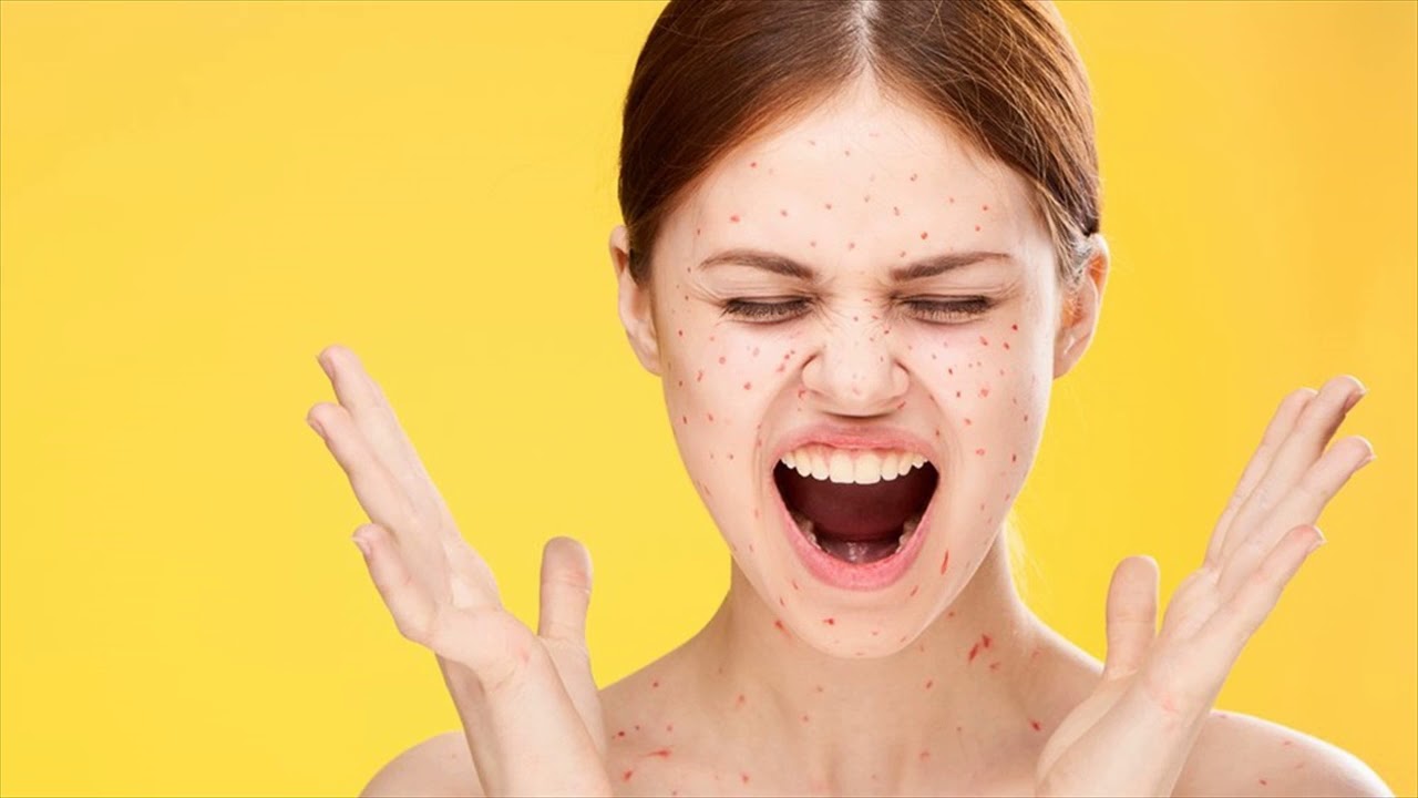 Tea Tree Oil Is Best For Chicken Pox How To Use YouTube