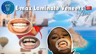 My smile makeover at Diamond dental Antalya Turkey| Emax laminate veneers&crowns to close my gap 