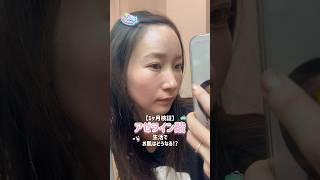 【1ヶ月検証】アゼライン酸生活でお肌はどうなる!?