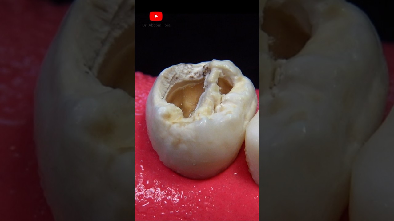 Удивительное удаление кариеса #шорты #стоматолог #удовлетворительно