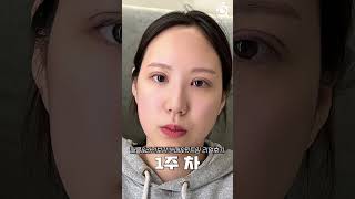 졸린 눈 1달만에 변화한 모습! 하니 성형외과 리얼 후기!!