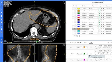 Introducing AutoContour: Automated AI Contouring Software