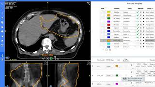 Introducing AutoContour: Automated AI Contouring Software