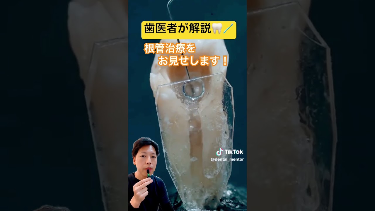 根管治療はこんな感じ🦷