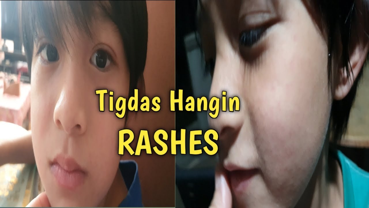 WALA NG LAGNAT SI SYMONE PERO DUMAMI ANG RASHES NIYA DAHIL SA TIGDAS wala-ng-lagnat-si-symone-pero-dumami-ang-rashes-niya-dahil-sa-tigdas