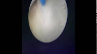 Posterior Üretral Valf Olgusunda Fetoskopik Lazer Ile Poterior Üretral Valf Ablasyonu