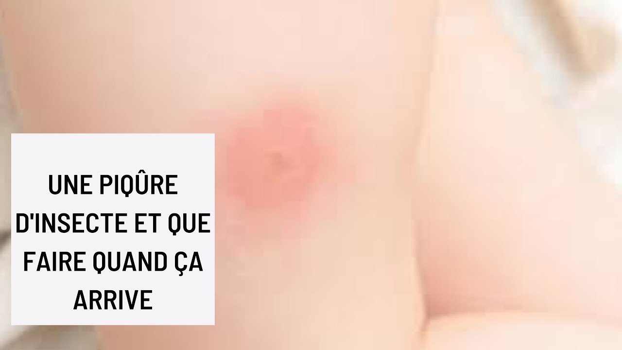 Quelle Piqure D Insecte Provoque Des Cloques