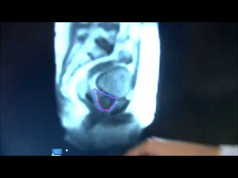 Videó: Az MRI értéke Az Atypia Endometrium Hiperplázia Kezelésében