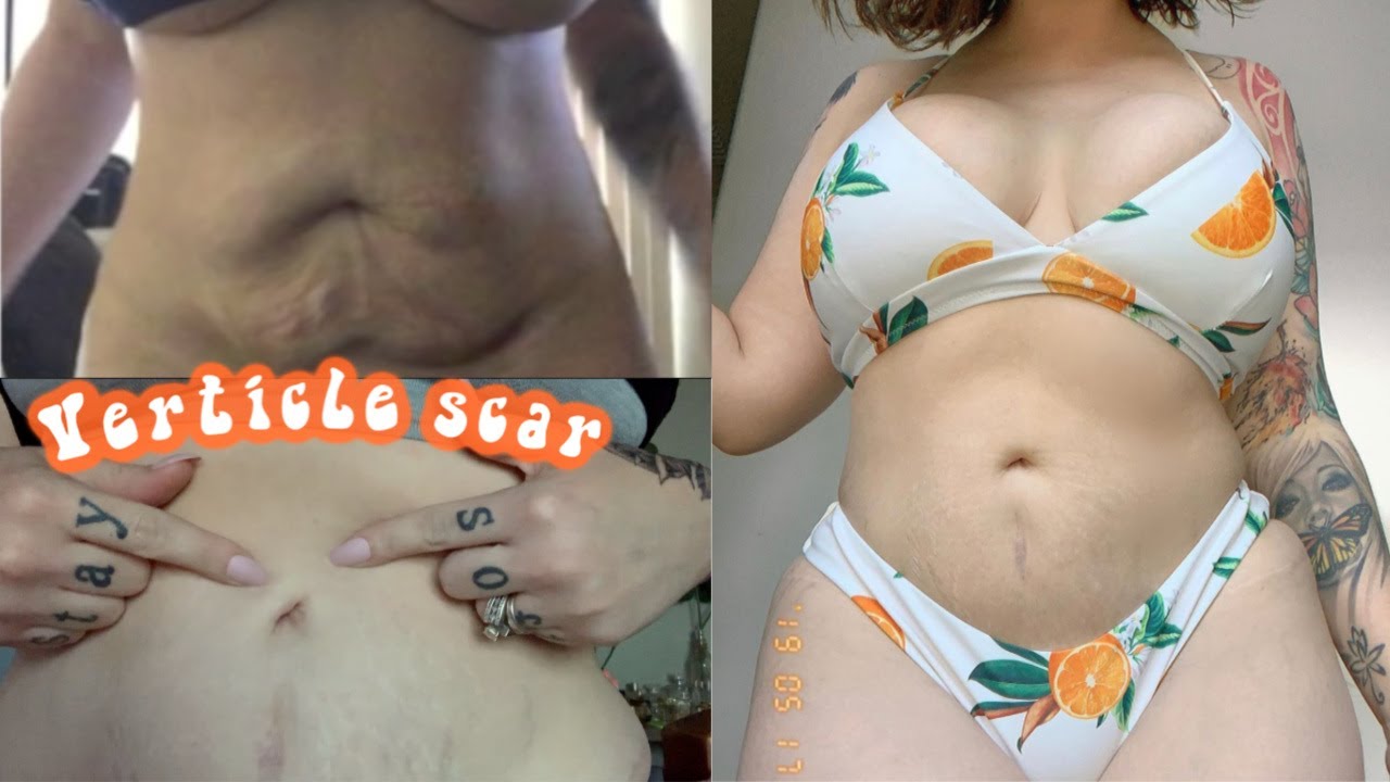 My Tummy Tuck / WHAT YOU NEED TO KNOW / 5 years post op 