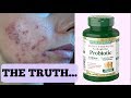 I STARTED TAKING PROBIOTICS FOR MY ACNE  || GETTING RID OF ACNE IN ONE WEEK EXPERIMENT