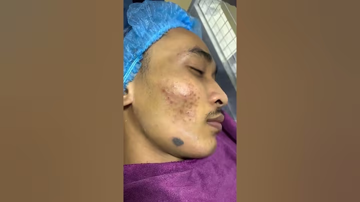 박효순의 아는 게 약] 물조심 귀조심 '외이도염 — 치료는 의사의 진단에 따라 적절한 약물을 바르고 항생제를 복용하는