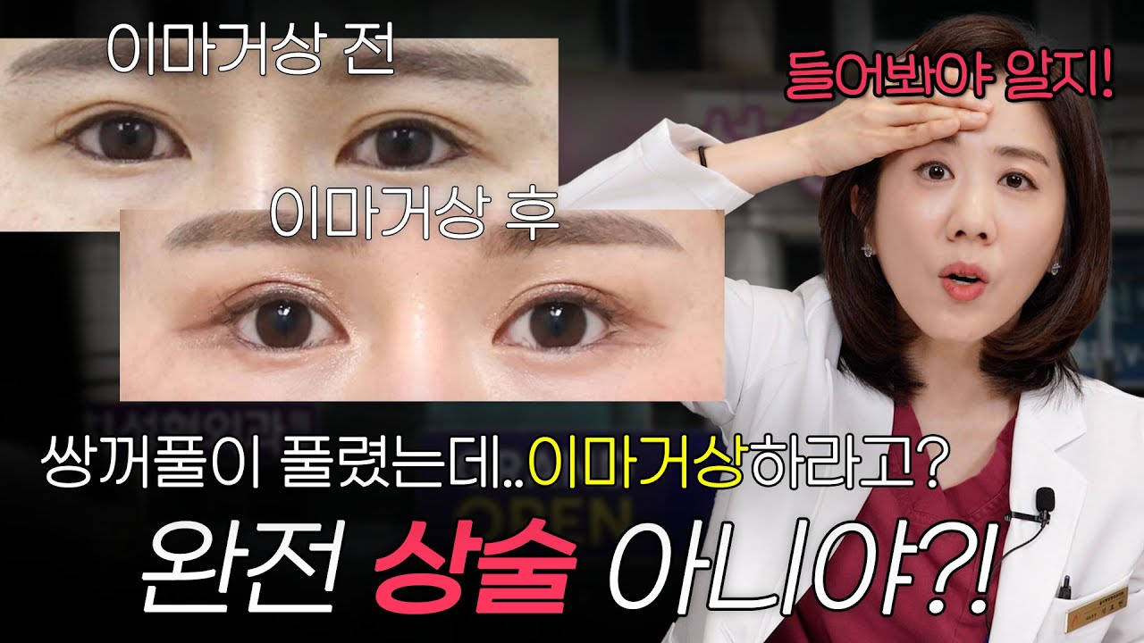 [Оллитинг гоо сайхны мэс заслын эмнэлэг] Давхар зовхины мэс засал хийлгэхээр очсон чинь хөмсөг өргөх мэс засал хийхийг санал болговол яах вэ? | Оллитинг гоо сайхны мэс засал