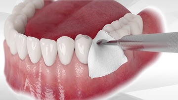 How to Perform Socket Grafting without Lifting a Flap with 3D Bond - Strauss Diamond