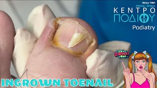 Ingrown toenail|Είσφρυση|Κέντρο Ποδιού Podiatry|Podiatrist #κεντροποδιου #calluses #νύχια #nails