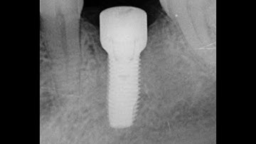 Tissue Level Implant Placement